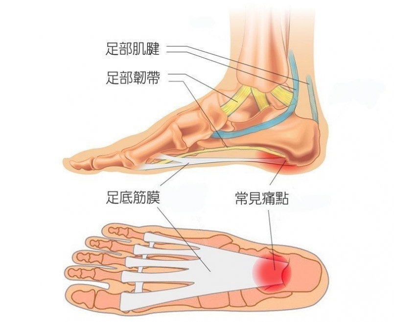 足底筋膜炎常見痛點示意圖